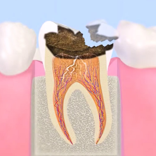 歯髄まで進行した虫歯 （C3）